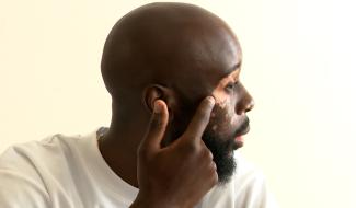 Vitiligo: apprendre à vivre avec le regard des autres
