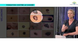 Mélanome et jeunes générations : un danger sous-estimé